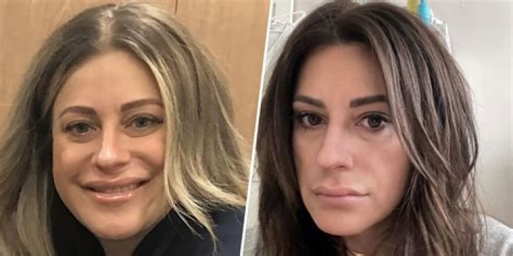 Celebrities Ozempic Face Before and After: Unveiling the Transformation