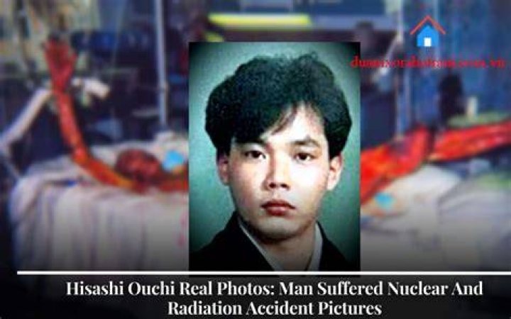 Hisashi Ouchi Photos: The Real Story Behind the Tragic Incident