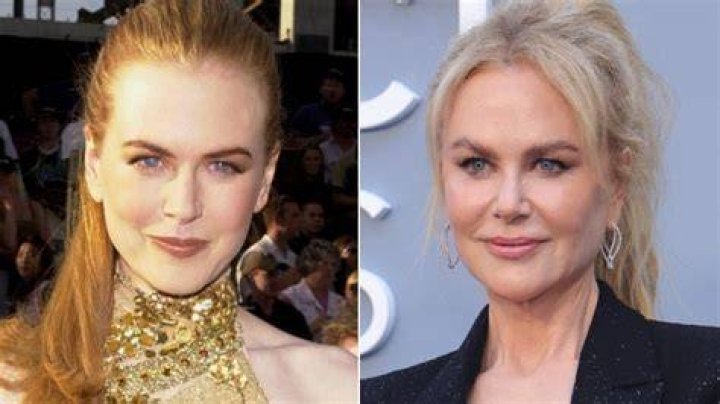 Nicole Kidman Cosmetic Surgery: Exploring the Transformations of a Hollywood Icon