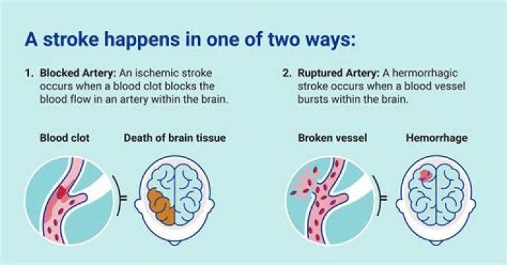 Pioneer Woman Stroke Cause of Death: Understanding the Impact of Stroke on Health