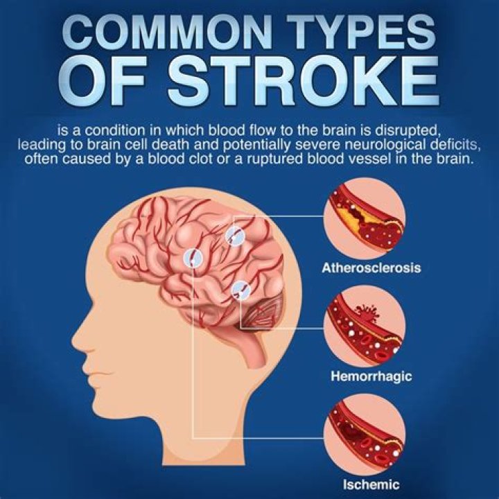 When Did Harry Connick Jr Have a Stroke? A Comprehensive Overview